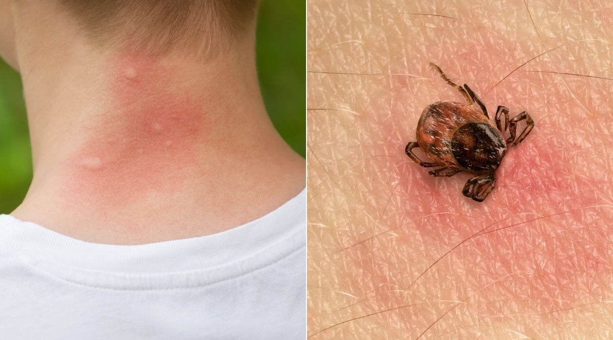 What Does A Tick Look Like How To Recognize Tick Bites On Humans And 352