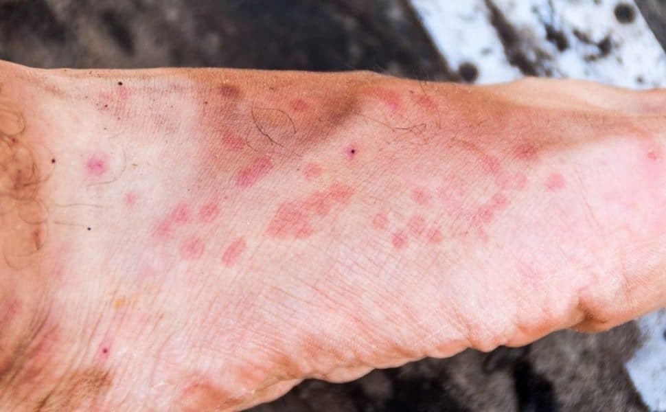 Scabies Bite on Feet