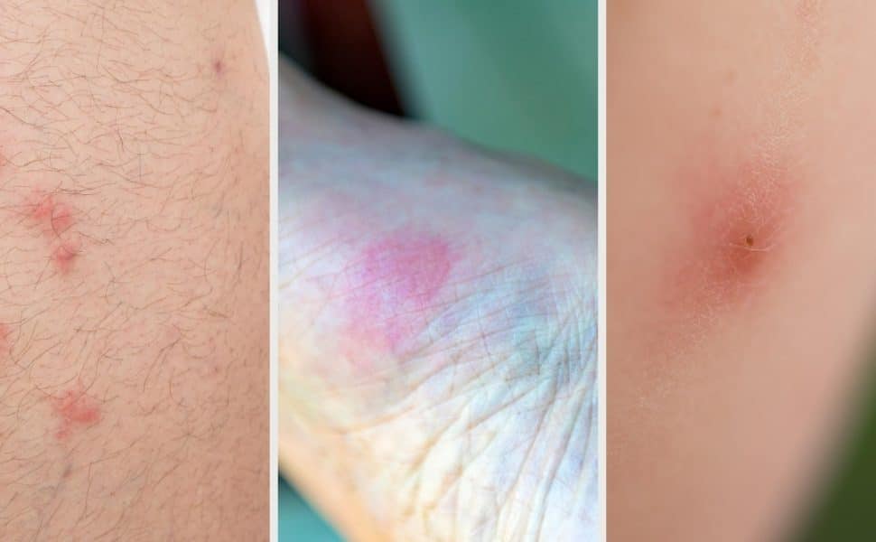 bed bugs vs fleas