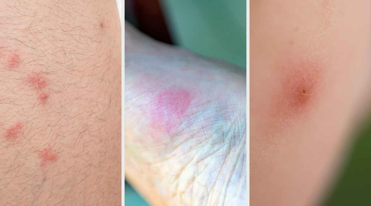 flea bites vs bed bugs