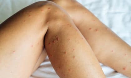 Dust Mite Bites on Legs