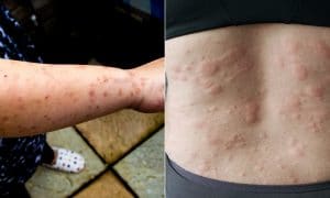 Bed Bug Bites vs Hives