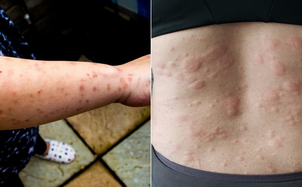 Bed Bug Bites vs Hives