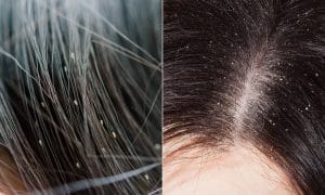 Head Lice vs Dandruff Close Up