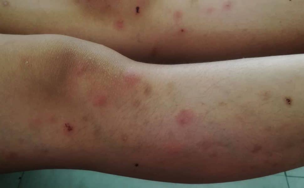 Human legs all covered in insect bites